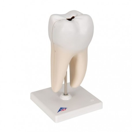 Radacina molar inferior cu prez cavitatilor (3B)