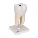 Radacina molar inferior cu prez cavitatilor (3B)