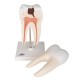 Radacina molar inferior cu prez cavitatilor (3B)