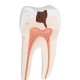 Radacina molar inferior cu prez cavitatilor (3B)